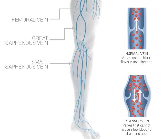 A chart of Femoral Vein, Great Saphenous Vein, and Small Saphenous Vein