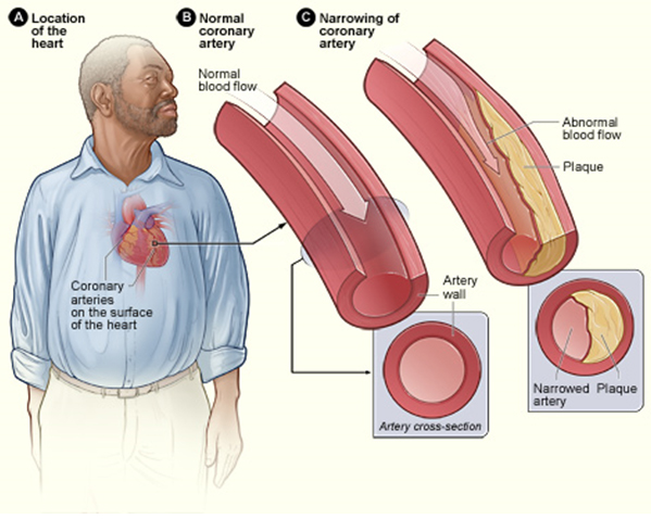 Narrowing of the arteries due to plaque build up